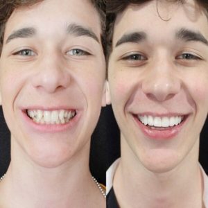 Brandon Rowland fixes his tooth for smile development