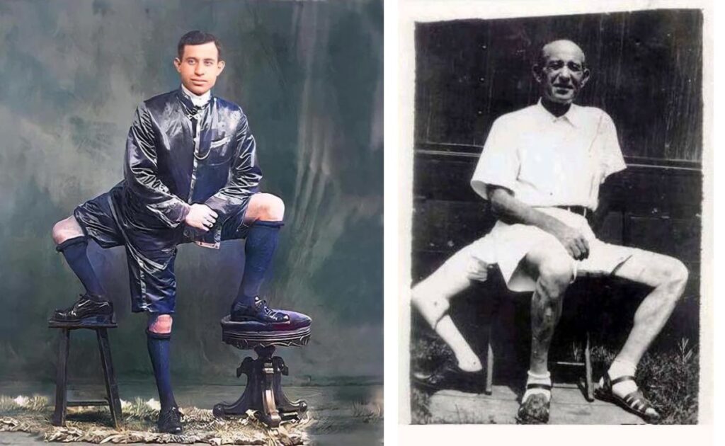 Who Was Frank Lentini? The Story of the man with three legs Who Was Frank Lentini? The Story of the man with three legs